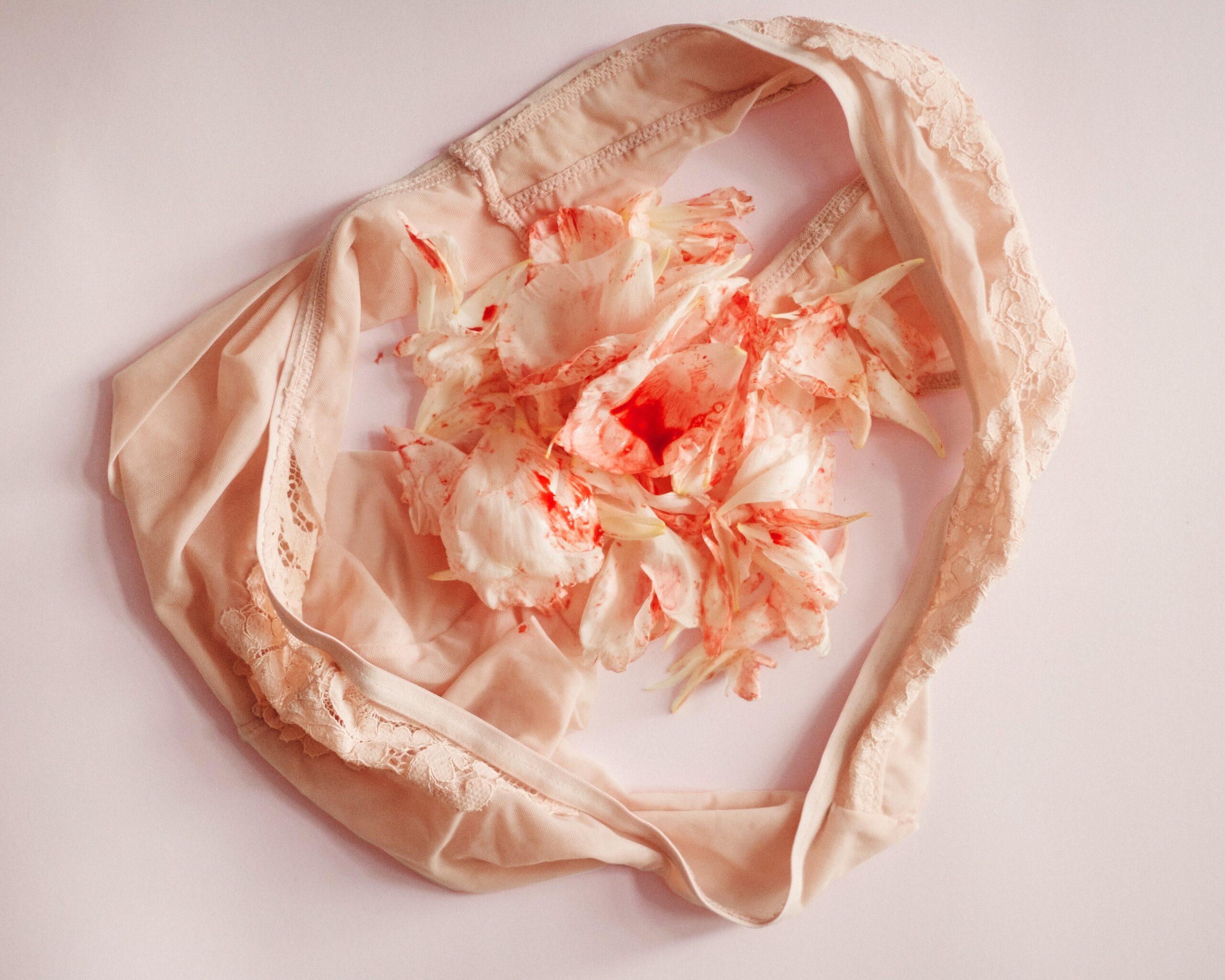 Définition de l&rsquo;endométriose